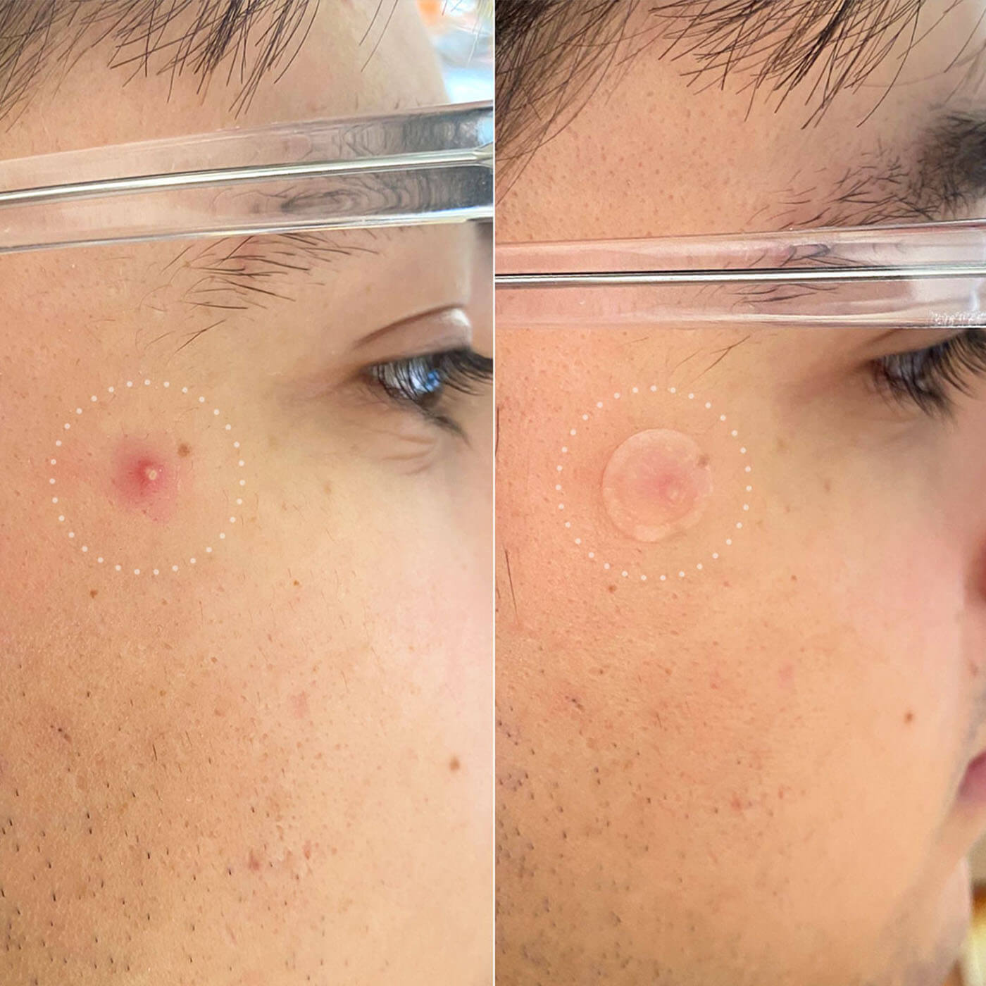 Patch ANTI-ACNÉ  de jour Invisible+ avec technologie hydrocolloïde